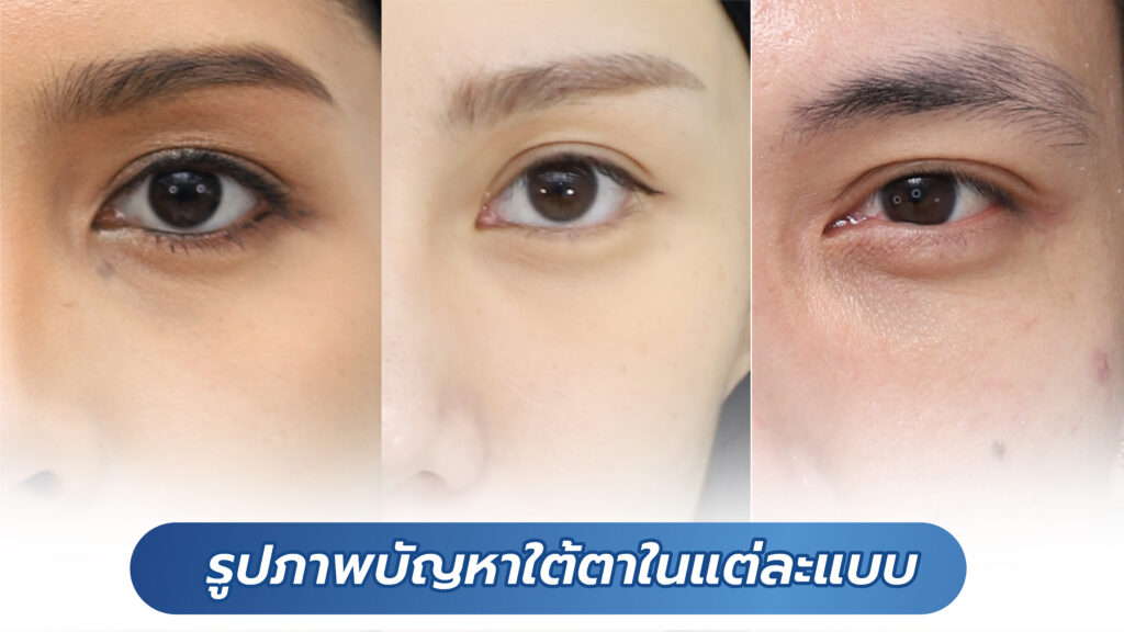 Pictures of problems under the eyes in each type