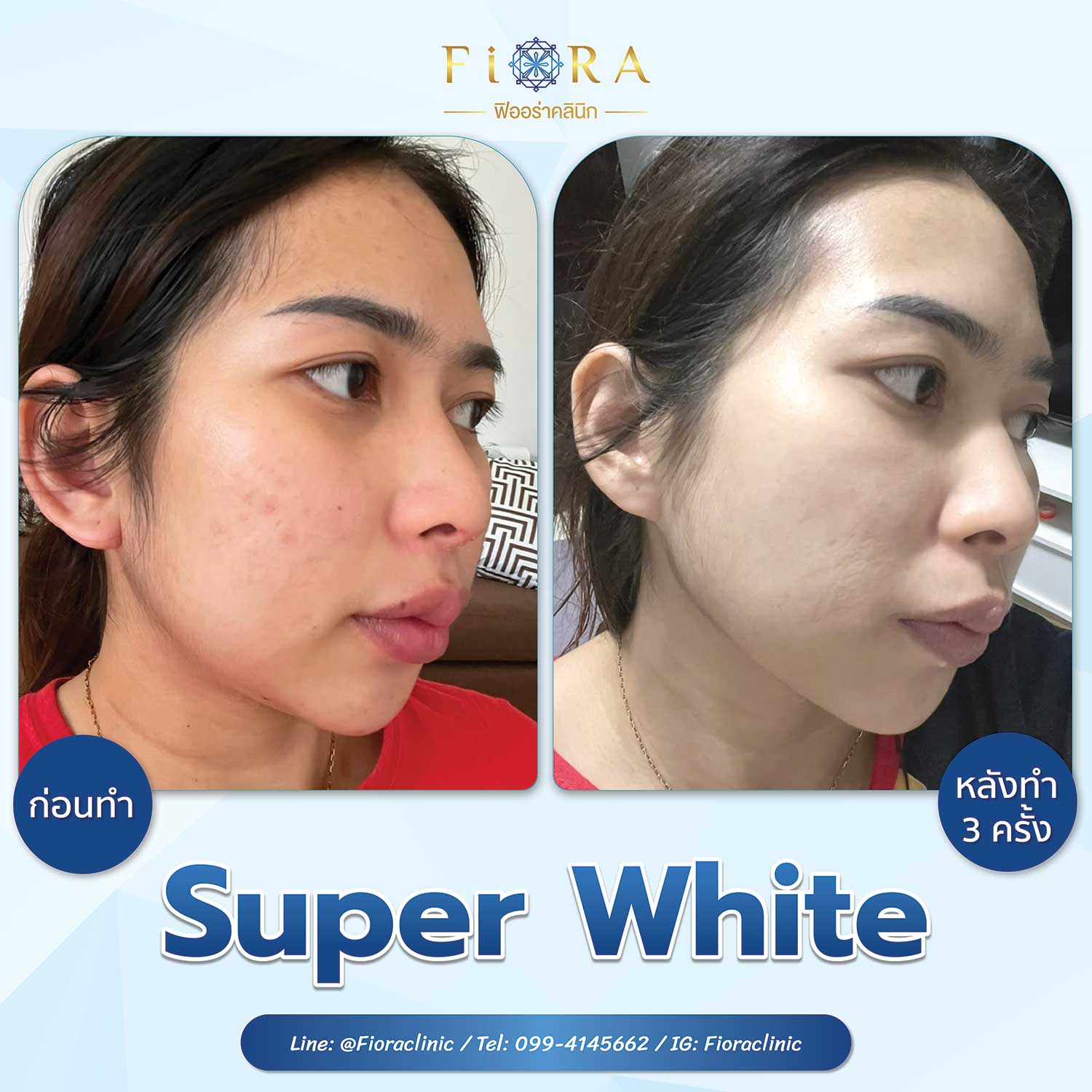 Review Meso Super White 1