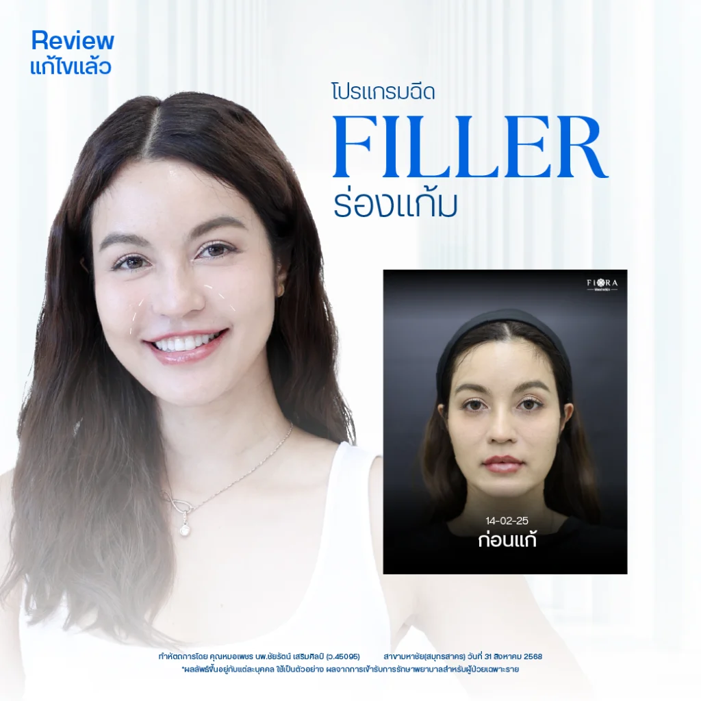 Review รีวิว Fillerร่องแก้ม