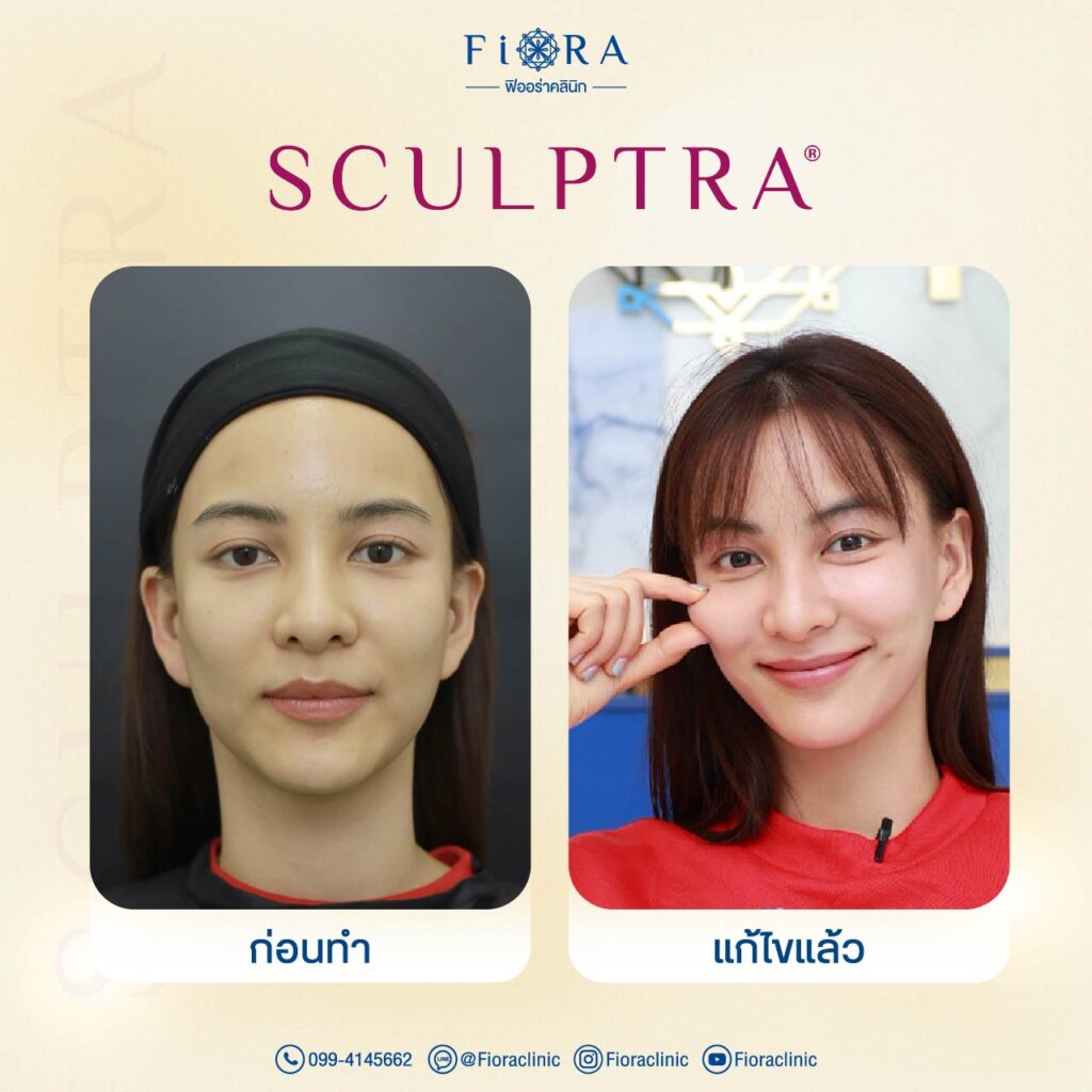 คุณกรีน อัษฎาพรณ์ กับการทำโปรแกรม Sculptra ที่ Fiora Clinic