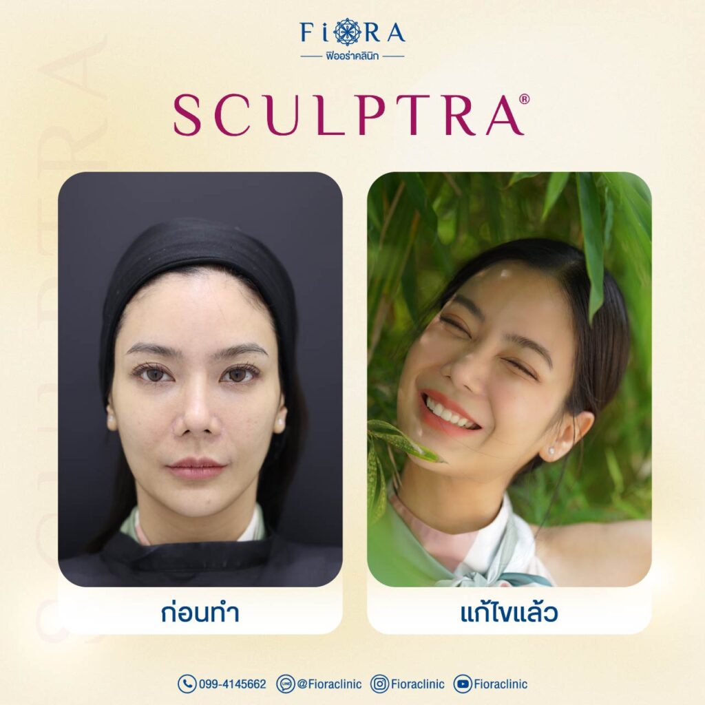 คุณก้อย กรกช กับการทำโปรแกรม Sculptra ที่ Fiora Clinic