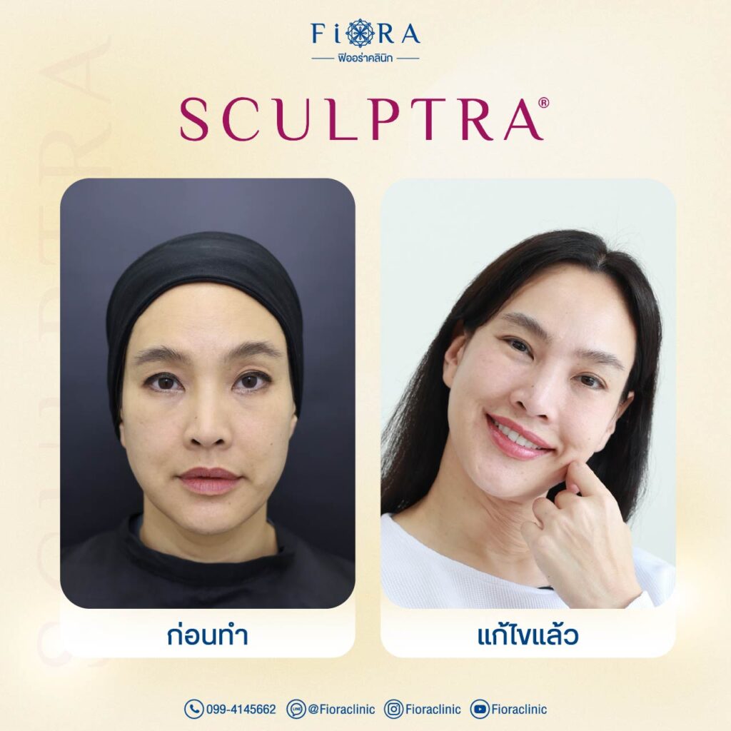 คุณตุ๊ก ชนกวนันท์ กับการทำโปรแกรม Sculptra ที่ Fiora Clinic