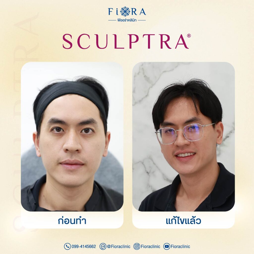 คุณทอม ถามจันทร์ กับการทำโปรแกรม Sculptra ที่ Fiora Clinic