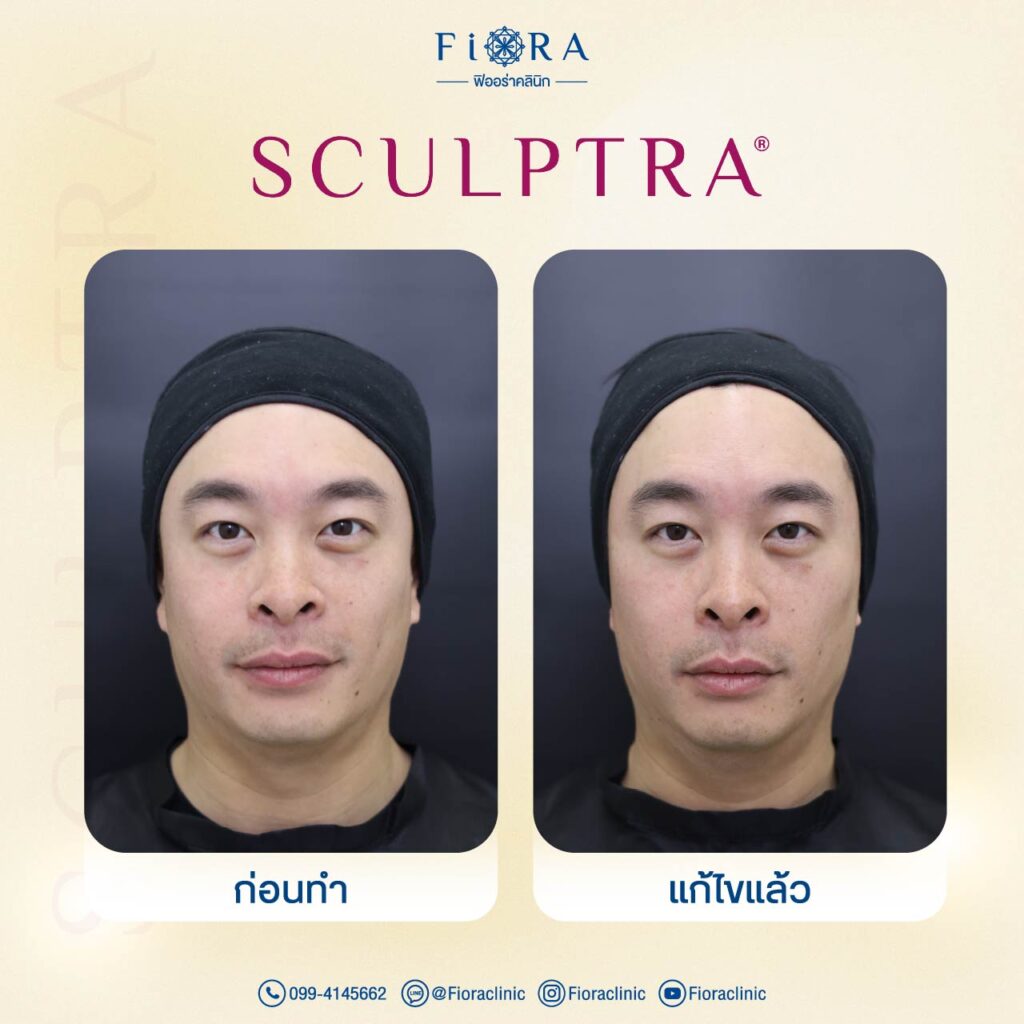 คุณนิก ธนิก แฟนคุณปาย สิตางศุ์ กับการทำโปรแกรม Sculptra ที่ Fiora Clinic