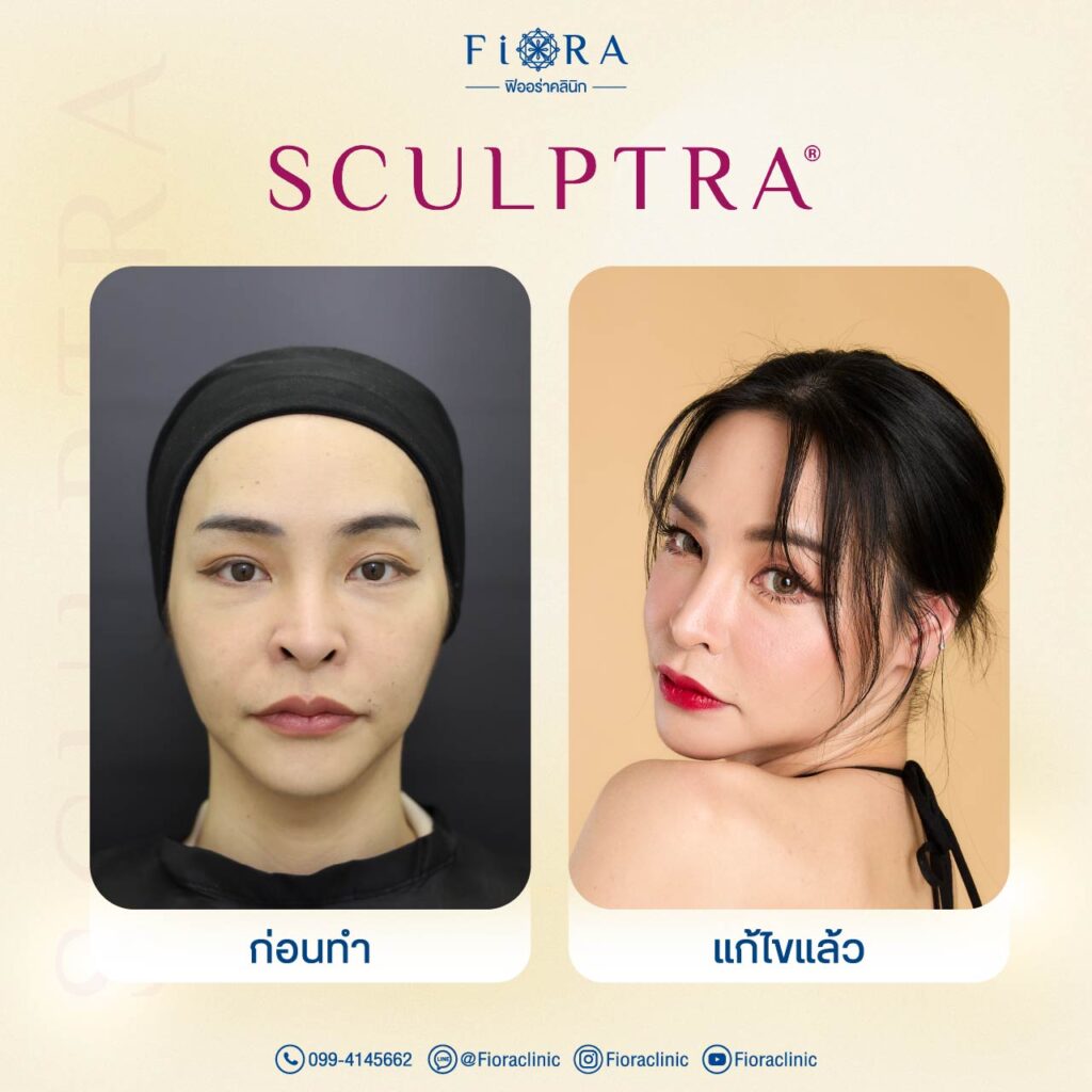 คุณบอลลี่ ผู้จัดการดารา กับการทำโปรแกรม Sculptra ที่ Fiora Clinic