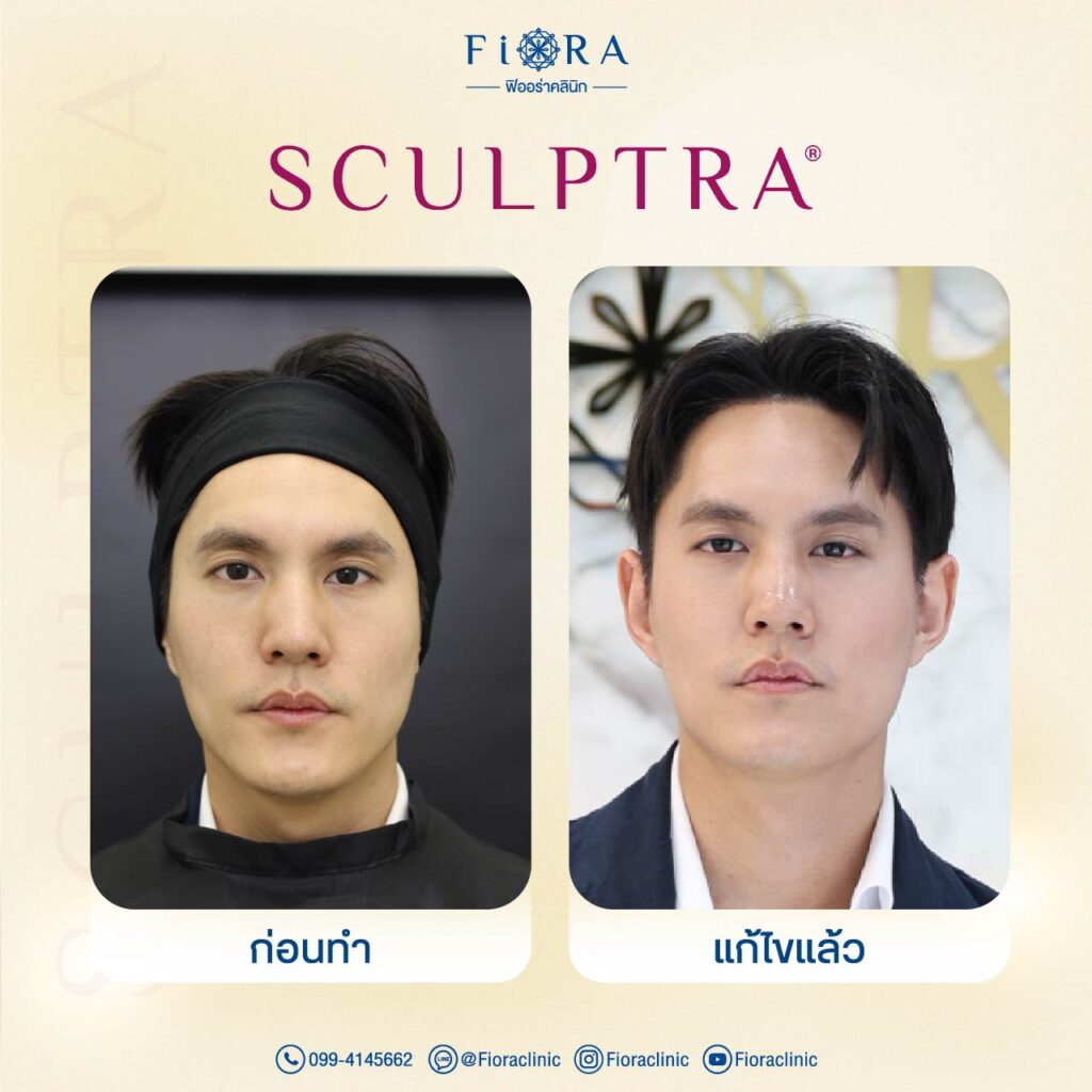 คุณบอส ดารา กับการทำโปรแกรม Sculptra ที่ Fiora Clinic