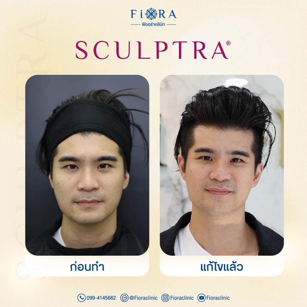 คุณปณต Getsunova กับการทำโปรแกรม Sculptra ที่ Fiora Clinic