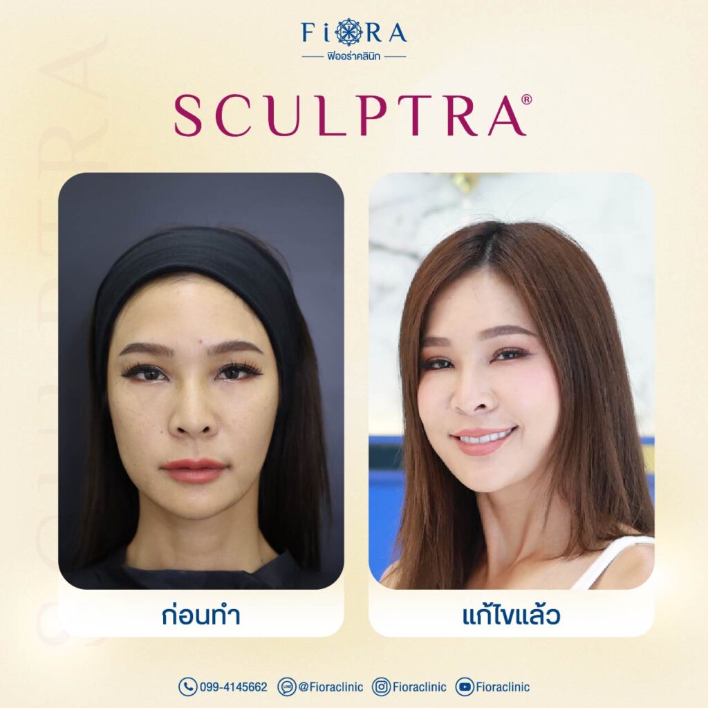 คุณปาย สิตางศุ์ กับการทำโปรแกรม Sculptra ที่ Fiora Clinic