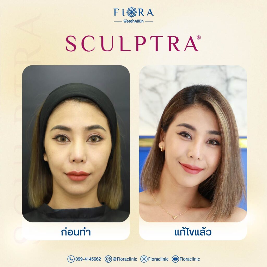 คุณปุ้ย แฟนคุณอาร์ต พศุตม์ กับการทำโปรแกรม Sculptra ที่ Fiora Clinic