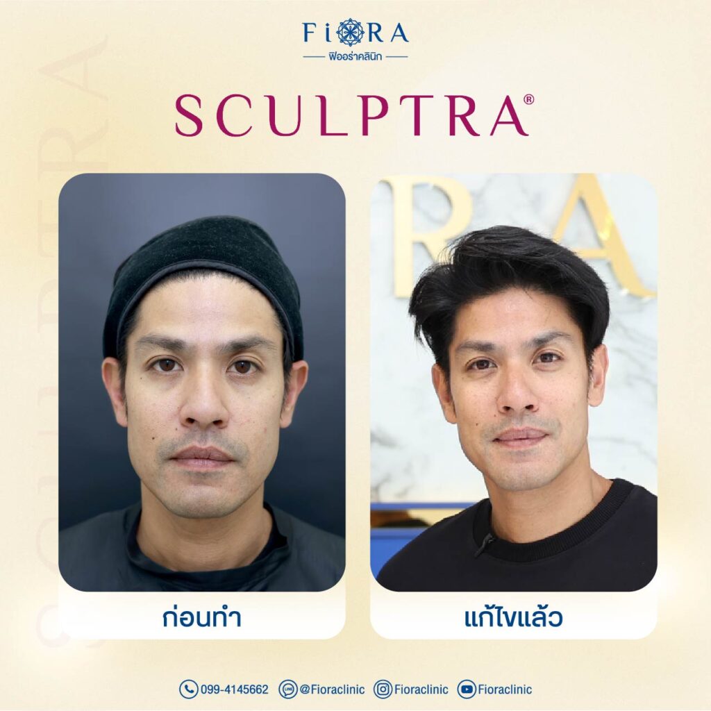 คุณภูริ กับการทำโปรแกรม Sculptra ที่ Fiora Clinic