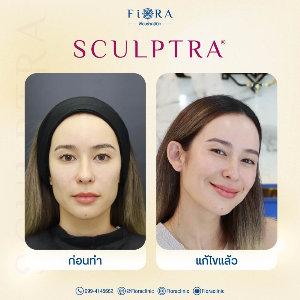 คุณมะลิ โคทส์ กับการทำโปรแกรม Sculptra ที่ Fiora Clinic