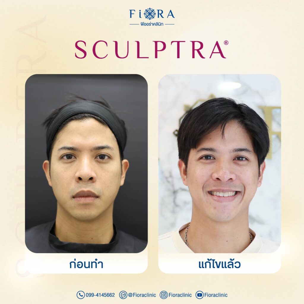 คุณอั้ม ถิระ กับการทำโปรแกรม Sculptra ที่ Fiora Clinic