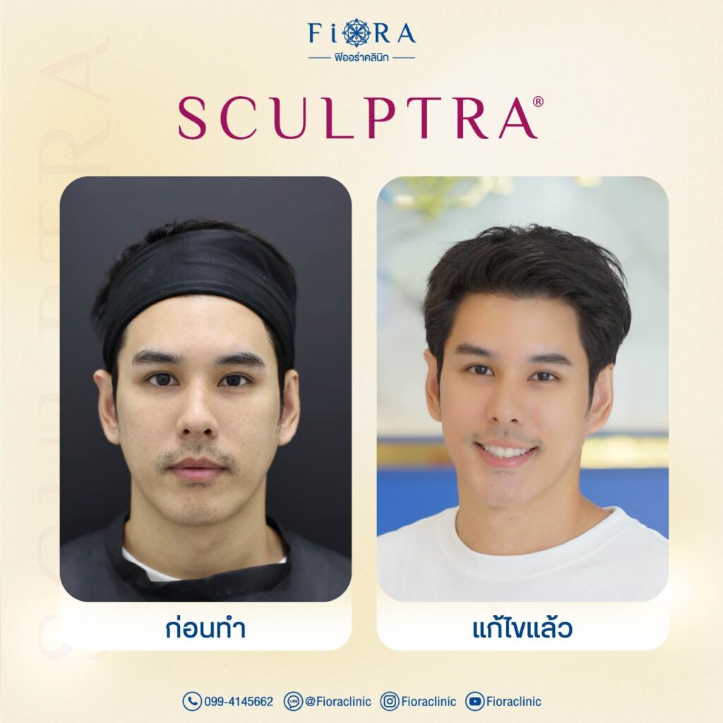 คุณอั๋น อัครพรรฒ กับการทำโปรแกรม Sculptra ที่ Fiora Clinic