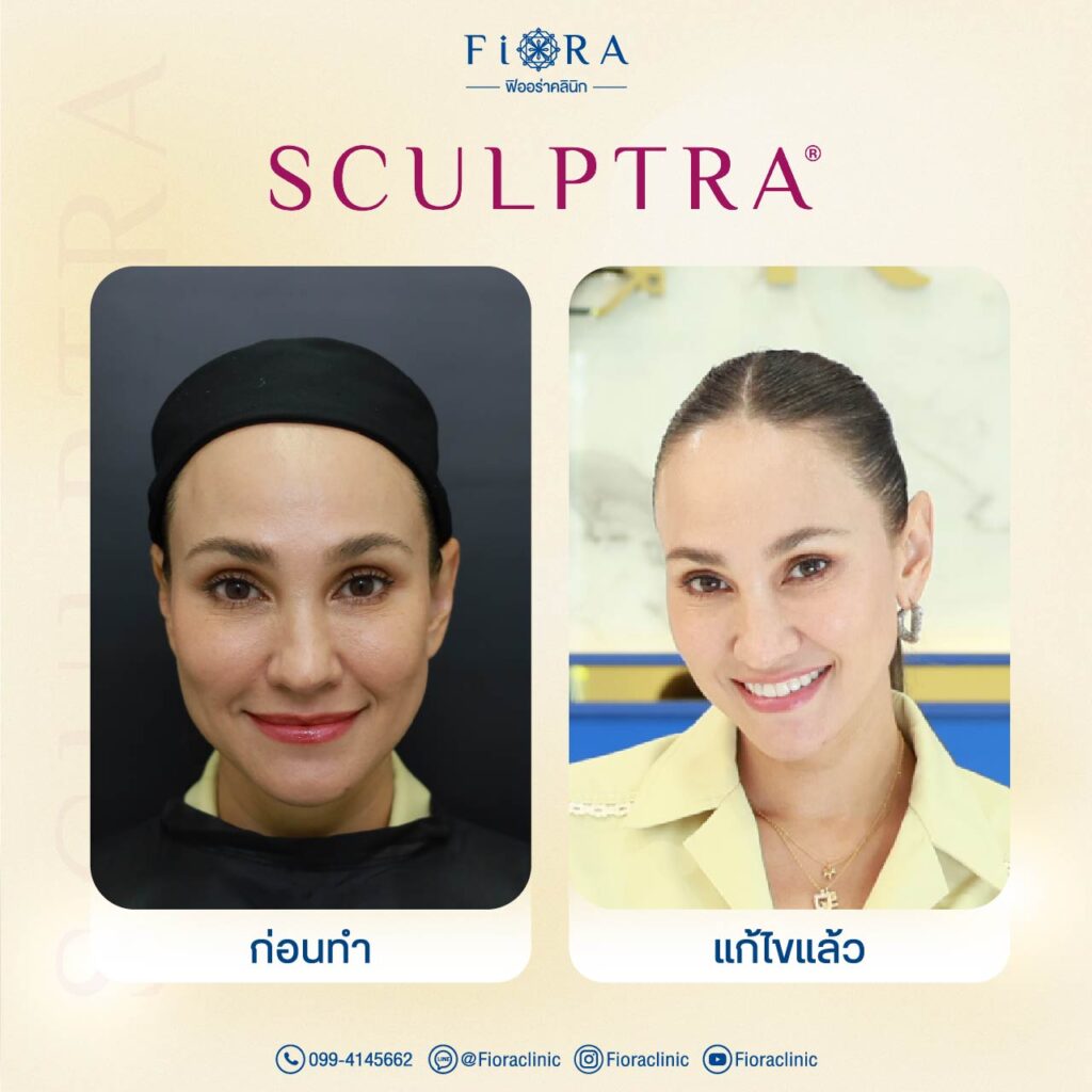 คุณเจน สุดา กับการทำโปรแกรม Sculptra ที่ Fiora Clinic