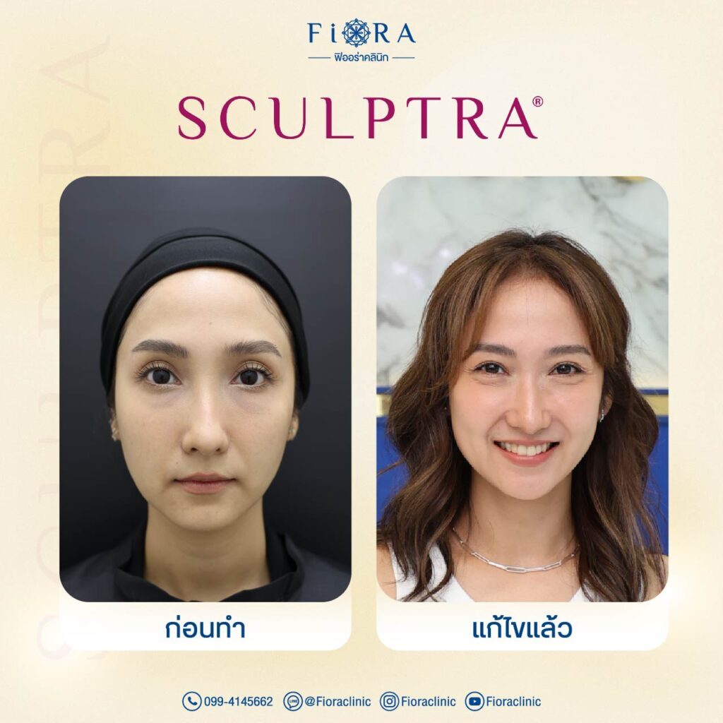 คุณเจี๊ยบ ชมพูนุช กับการทำโปรแกรม Sculptra ที่ Fiora Clinic