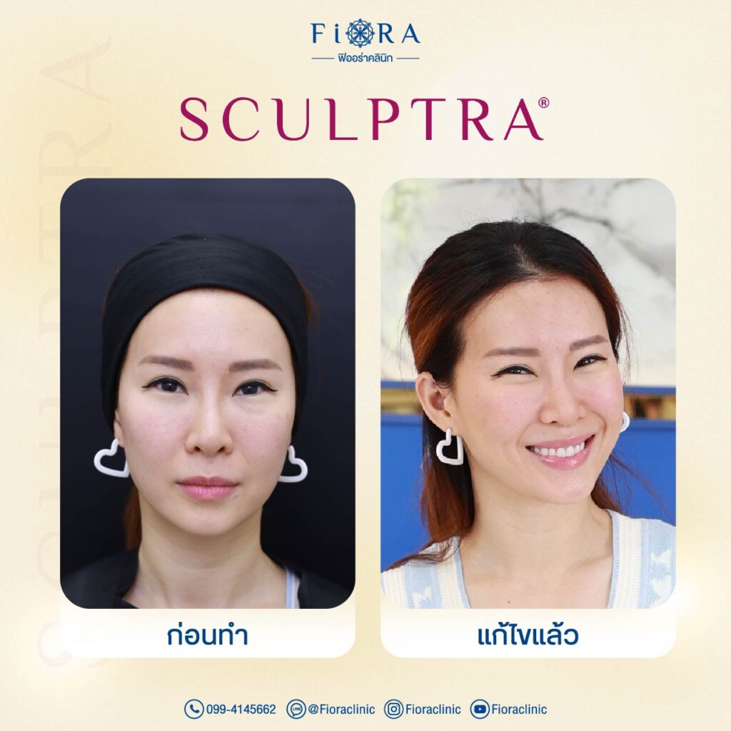 คุณเบลล์ Girly Berry กับการทำโปรแกรม Sculptra ที่ Fiora Clinic