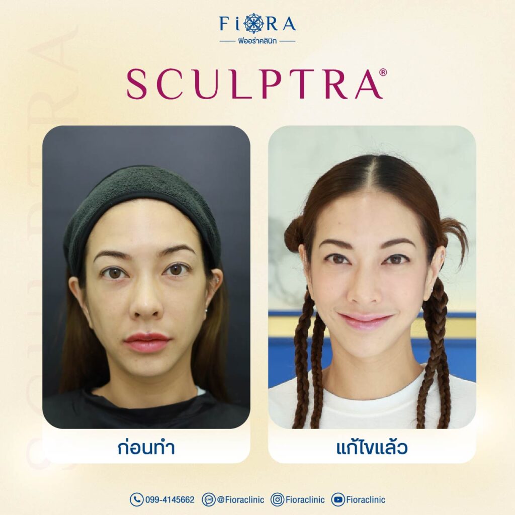 คุณแป้ง อรจิรา กับการทำโปรแกรม Sculptra ที่ Fiora Clinic