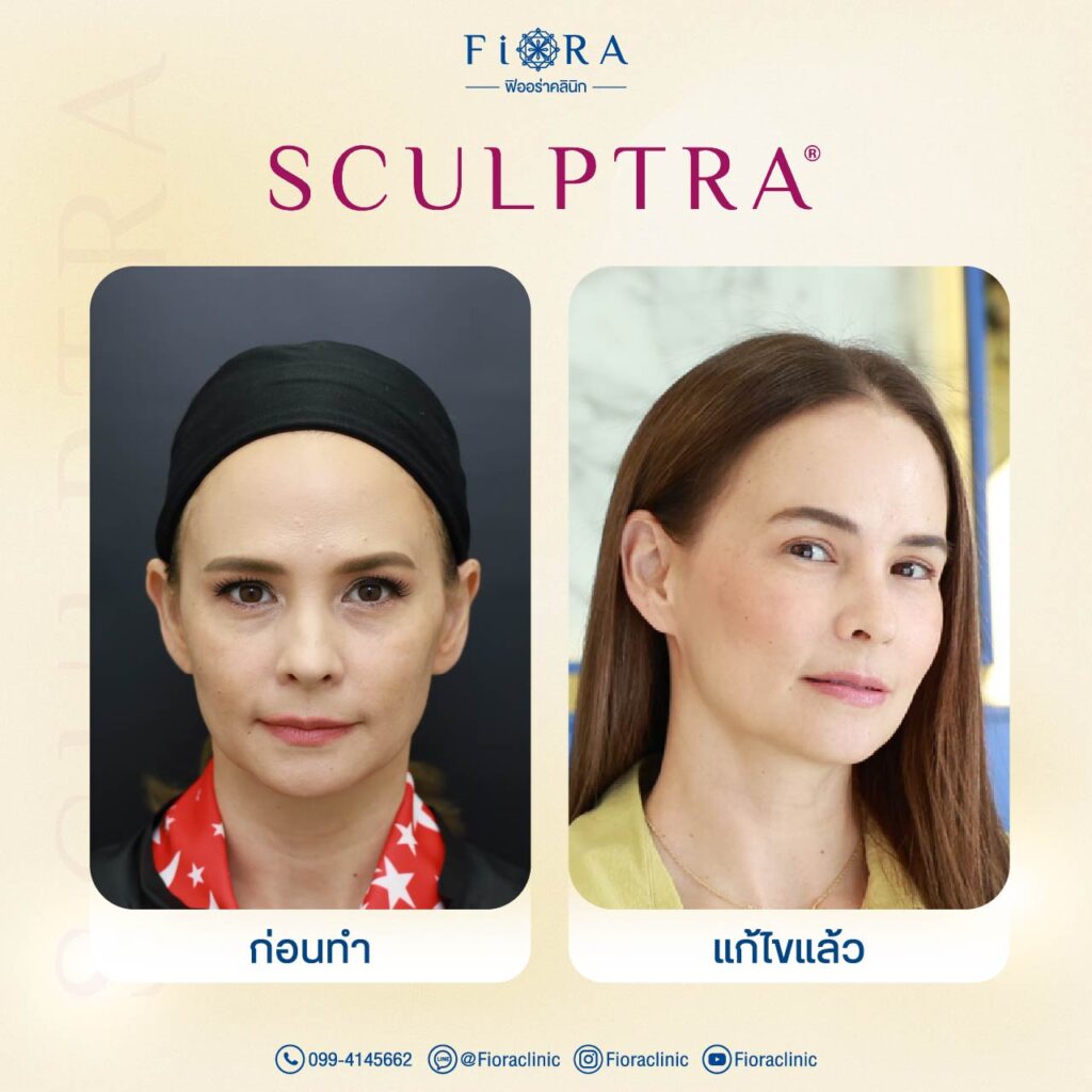 คุณแอน อลิชา กับการทำโปรแกรม Sculptra ที่ Fiora Clinic