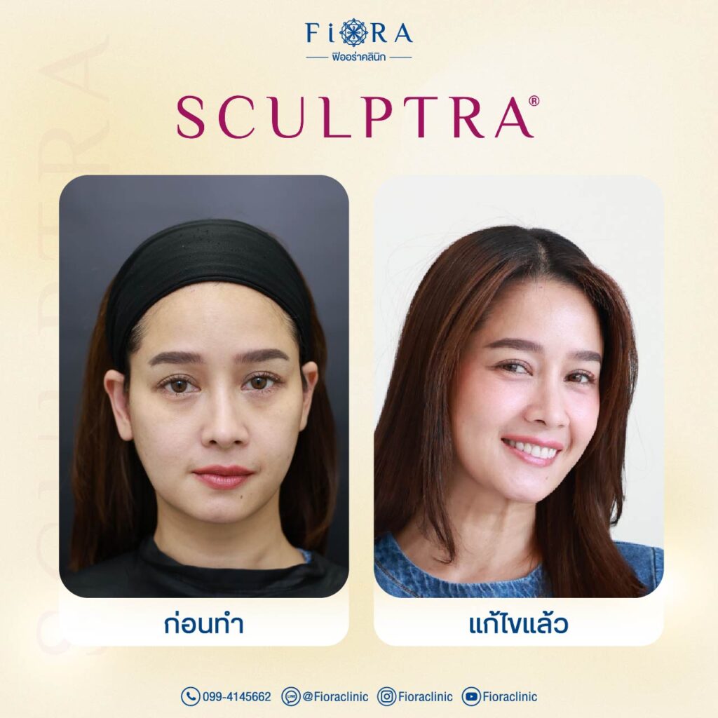 คุณโม อมีนา กับการทำโปรแกรม Sculptra ที่ Fiora Clinic