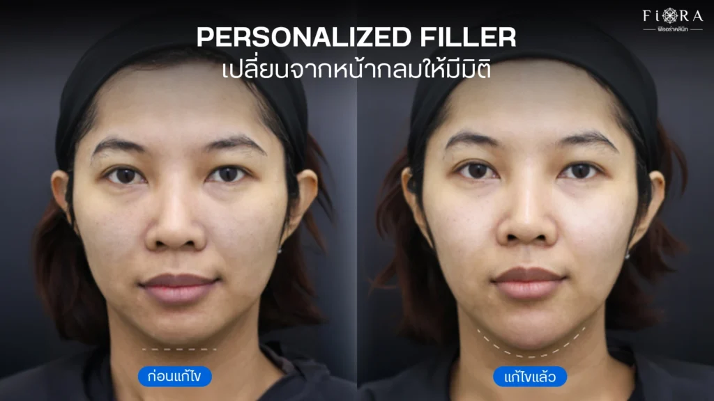 BeforeAfter