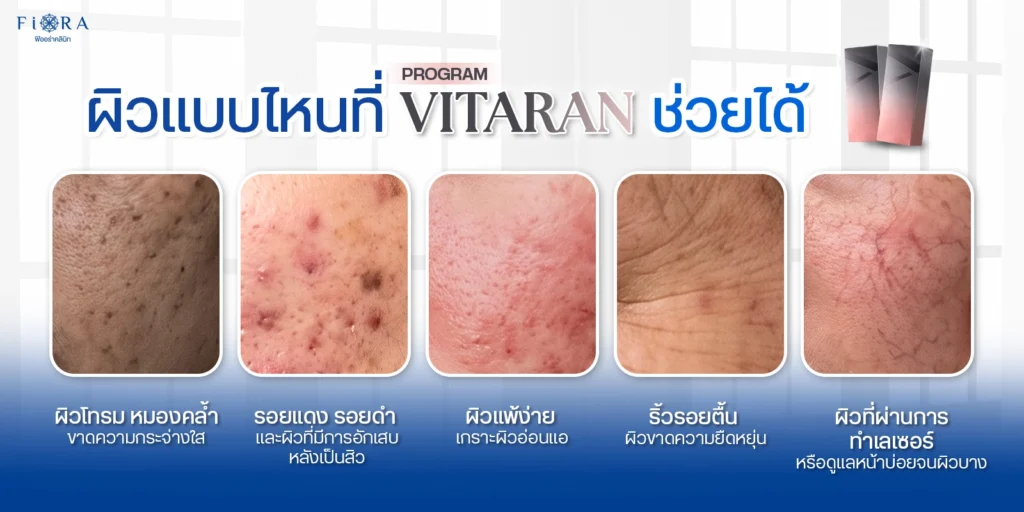 ผิวแบบไหนที่ vitarun ช่วยได้